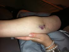 Mummy's arm Mummy's arm